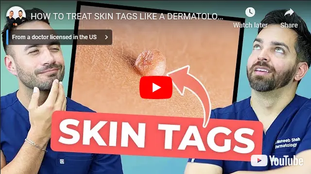 skin tag